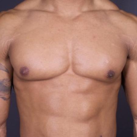 After image 1 Case #84876 - Excision of Left Gynecomastia