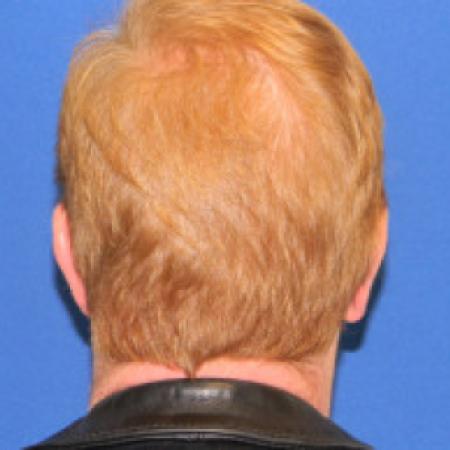 After image 2 Case #88341 - Otoplasty