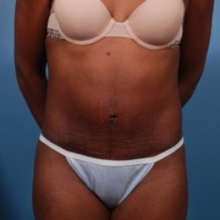 After image 1 Case #78871 - Abdominoplasty