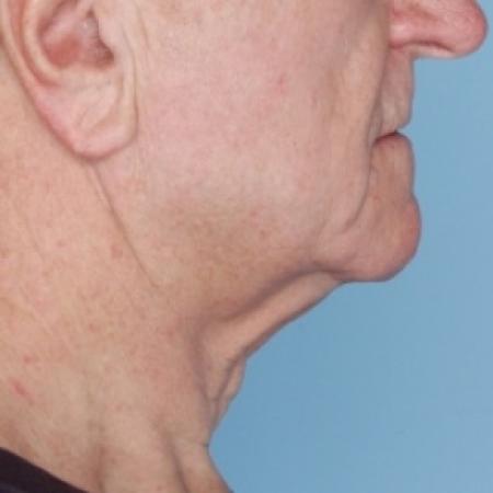After image 3 Case #80626 - Ulthera