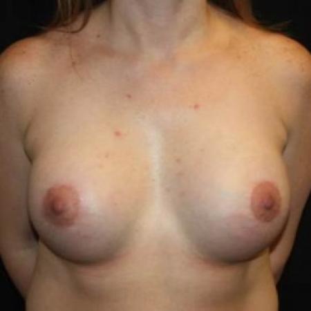 After image 1 Case #85106 - Breast Lift with Implants - 40 year old female