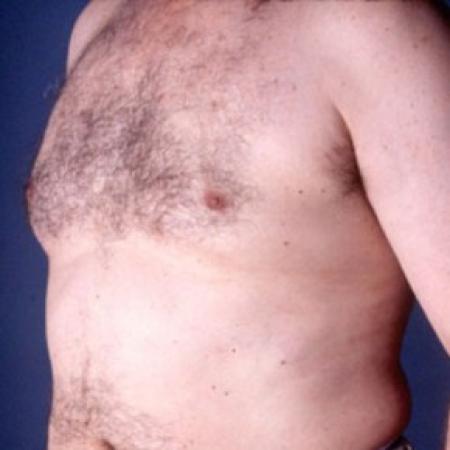 After image 2 Case #81516 - Gynecomastia