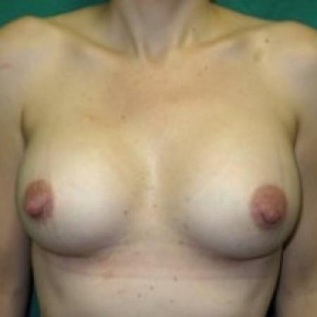 After image 1 Case #85786 - Breast Augmentation 