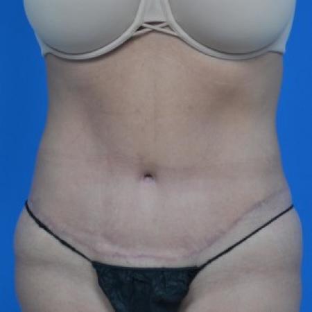 After image 1 Case #87881 - Tummy Tuck