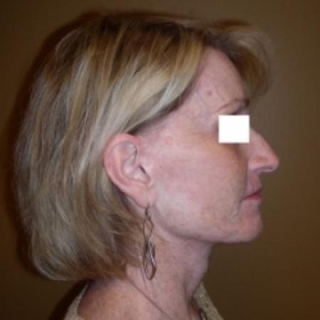 After image 3 Case #79801 - Sculptra