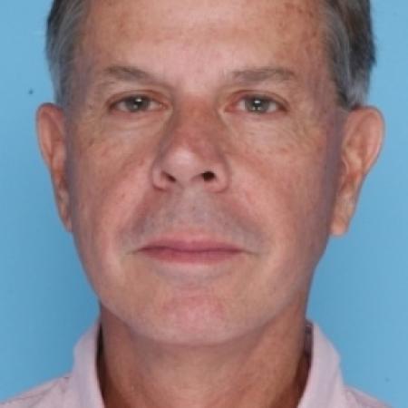 After image 1 Case #79686 - Facelift