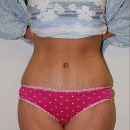 After image 1 Case #85811 - Traditional abdominoplasty after children