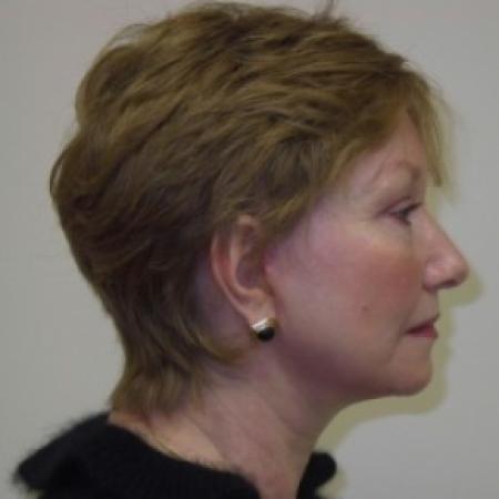 After image 2 Case #81041 - Facelift