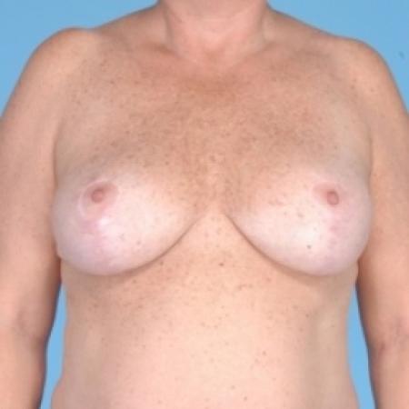 After image 1 Case #79711 - Bilateral Breast Reduction 