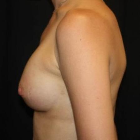 After image 3 Case #84926 - Breast Augmentation - 33 year old female