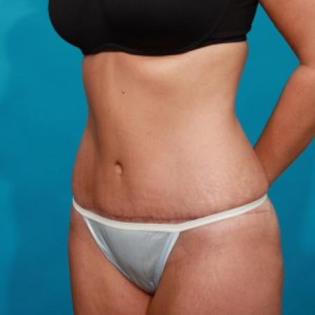 After image 2 Case #84071 - Abdominoplasty with Flank Lipo