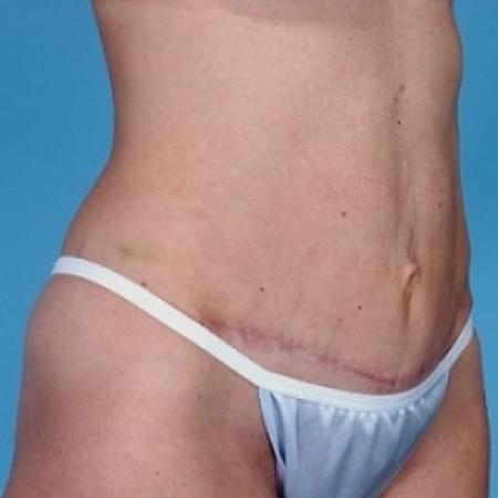 After image 3 Case #79161 - Tummy Tuck