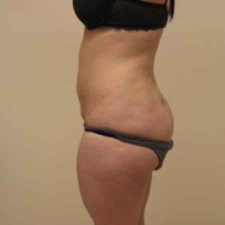 After image 3 Case #81156 - Liposuction