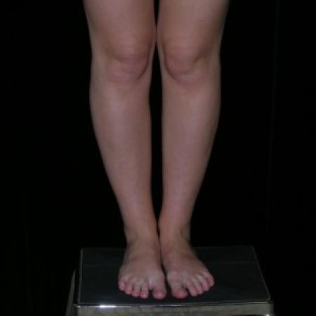 After image 1 Case #81936 - Calf and Ankle Liposculpture