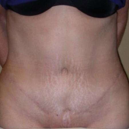 After image 1 Case #79781 - Tummy Tuck