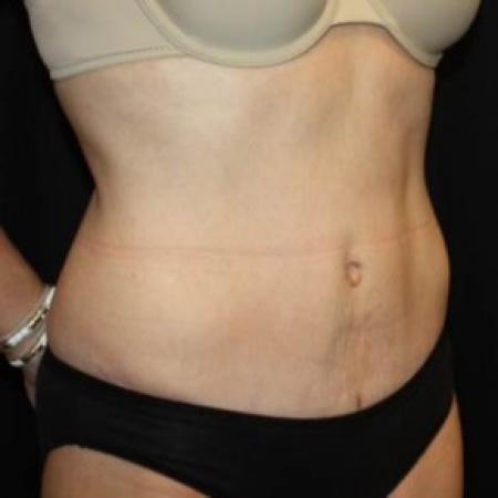 After image 2 Case #85051 - Abdominoplasty - 47 year old female