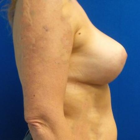 After image 3 Case #87241 - Breast Augmentation/Mastopexy