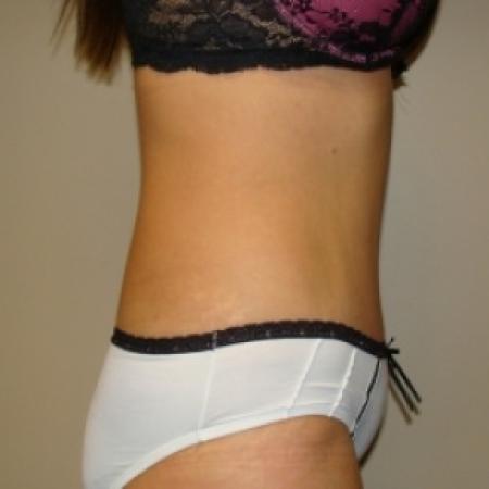 After image 4 Case #80116 - Abdominoplasty