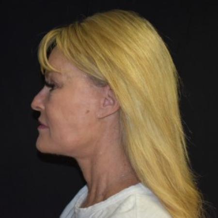 After image 3 Case #87426 - 57 year old female treated for aging face and neck