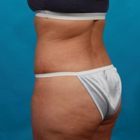 After image 4 Case #85746 - Abdominoplasty with Flank Liposuction
