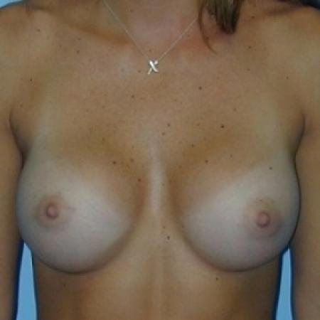 After image 1 Case #79091 - Saline Breast Implants