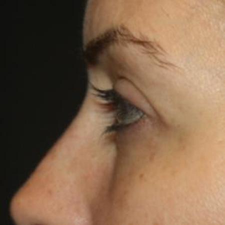 After image 3 Case #85846 - Blepharoplasty - Upper and Lower Lids - 42 year old female