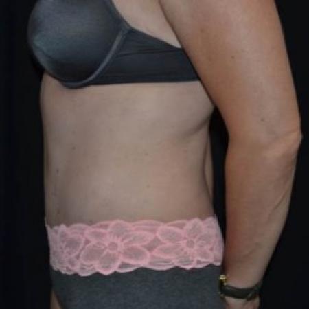 After image 3 Case #83766 - Abdominoplasty - 47 year old female.