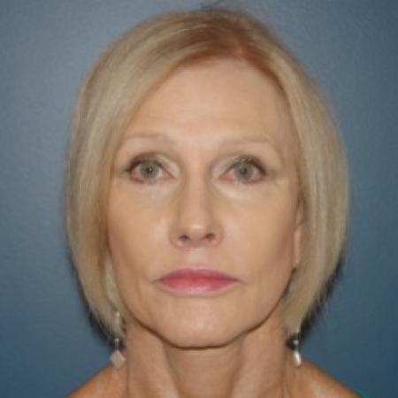 After image 1 Case #81241 - Facelift and Eyelid surgery