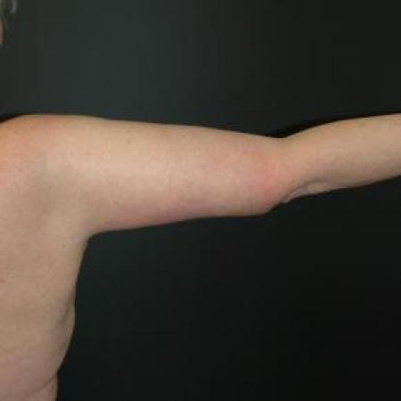After image 1 Case #80896 - Brachioplasty Procedure