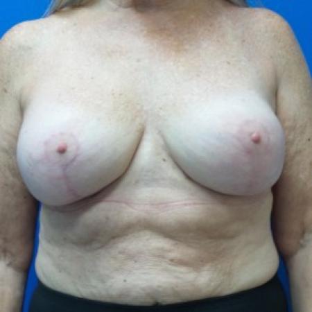 After image 1 Case #87281 - Breast Augmentation Revision