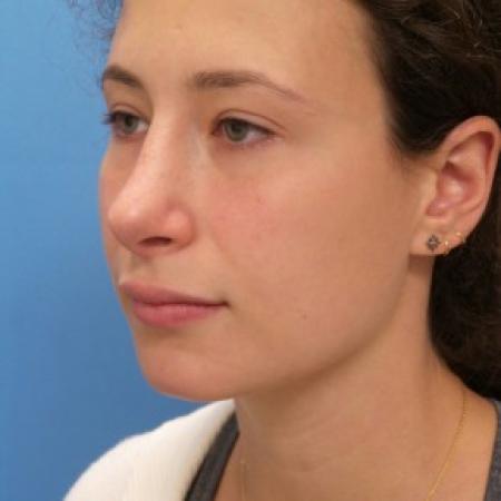 After image 2 Case #86456 - Rhinoplasty - 3 months post-op