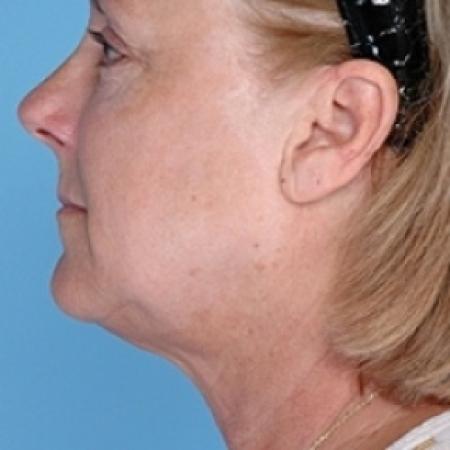 After image 2 Case #79206 - Liposuction