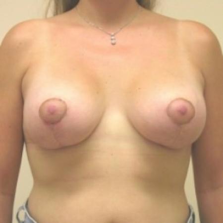 After image 1 Case #81121 - Bilateral breast lift with saline implants