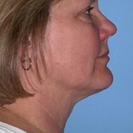 After image 2 Case #79216 - Liposuction