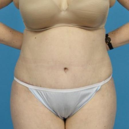 After image 1 Case #84076 - Abdominoplasty with Flank Lipo
