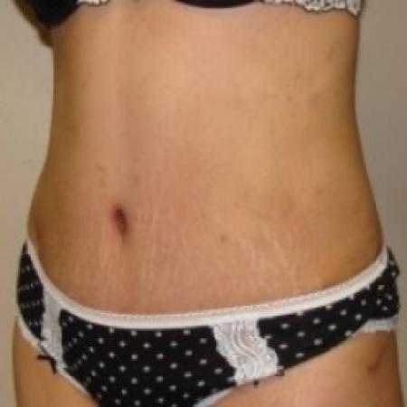 After image 2 Case #79481 - Tummy Tuck