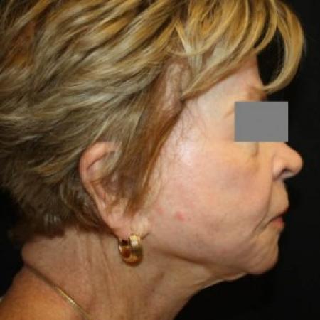 After image 3 Case #85601 - Phenol and Croton Oil Peel - 76 year old female