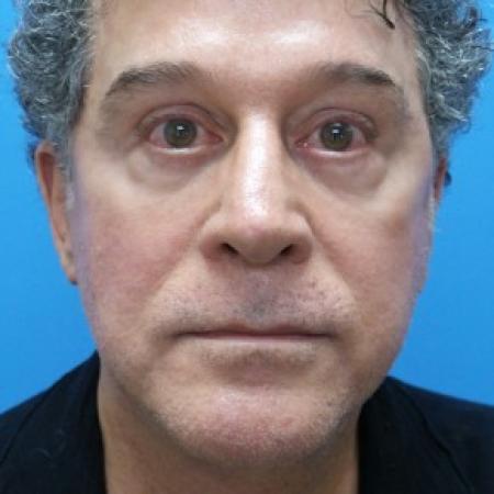 After image 1 Case #86716 - Facelift/Upper Blepharoplasty/Browlift - 1 year post-op