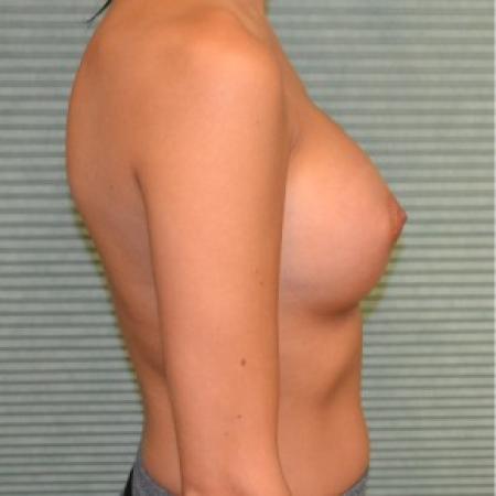 After image 3 Case #87766 - Breast Augmentation with Mentor MemoryGel smooth round 350cc high profile