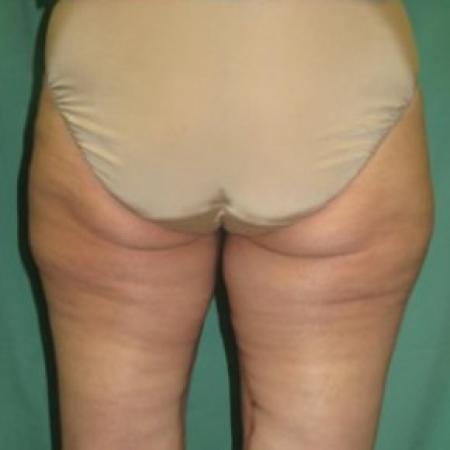 After Case #85671 - Thigh Lift 