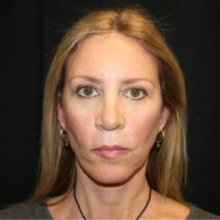 After image 1 Case #85271 - Facelift and Neck Lift - 49 year old female