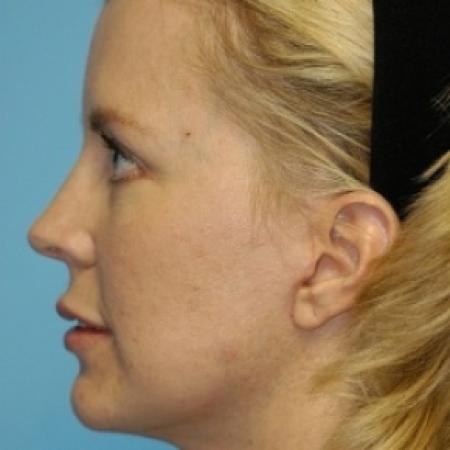 After image 3 Case #79676 - Lip Grafting