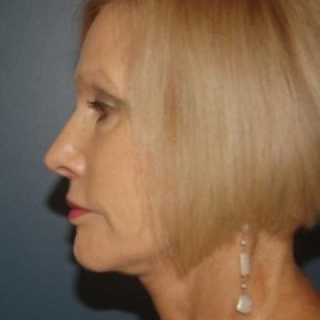 After image 3 Case #81241 - Facelift and Eyelid surgery