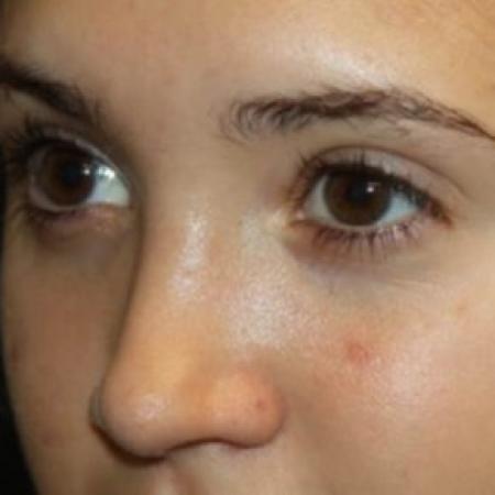 After image 2 Case #85141 - Rhinoplasty - 17 year old female