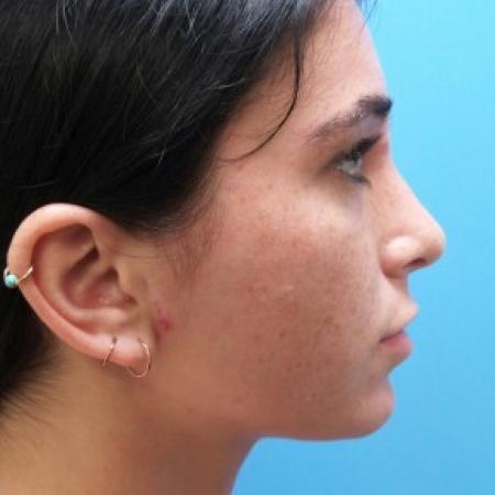 After image 3 Case #87441 - 21 year old  -  Rhinoplasty  -  6 months post-op