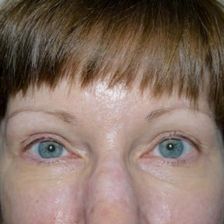 After image 1 Case #82466 - 55 year old 2 years after Endoscopic Brow Lift and Upper Blepharoplasty