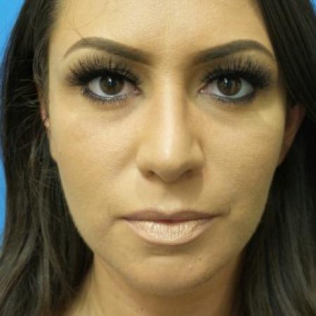 After image 1 Case #86756 - Rhinoplasty - 3 months post-op