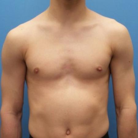 After image 1 Case #87306 - 17-year old  -  Excisional Gynecomastia right breast