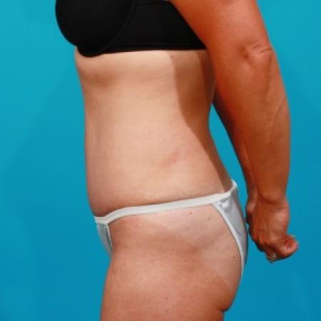 After image 3 Case #80741 - Tummy Tuck