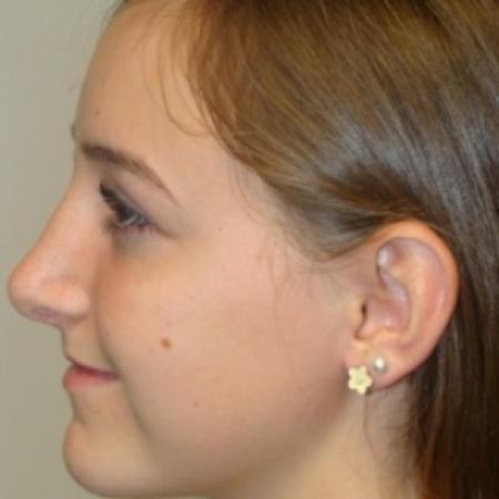 After image 3 Case #80406 - Open Rhinoplasty